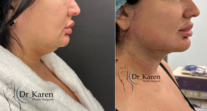 Пациентка пластического хирурга Карена Пайтяна. Фото до операции и сразу после липомоделирования подбородка