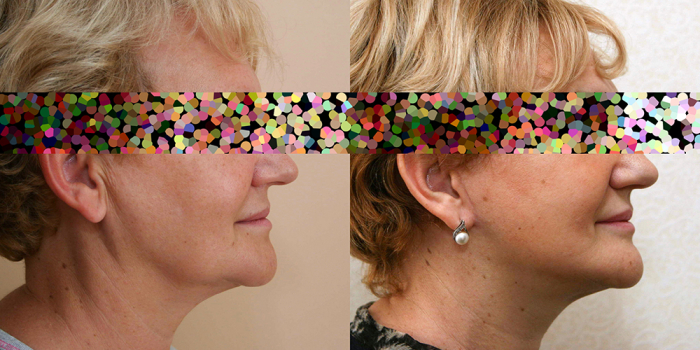 Александр Жуков подтяжка лица