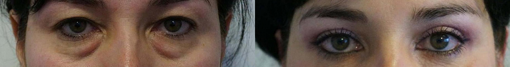 Пациентка пластического хирурга Арслана Пенаева до и после верхней и нижней блефаропластики