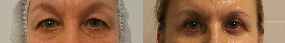 Пациентка пластического хирурга Арслана Пенаева до и после верхней блефаропластики