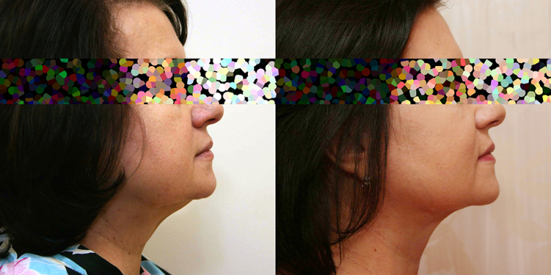 Пациентка доктора Александра Жукова до и после подтяжки лица