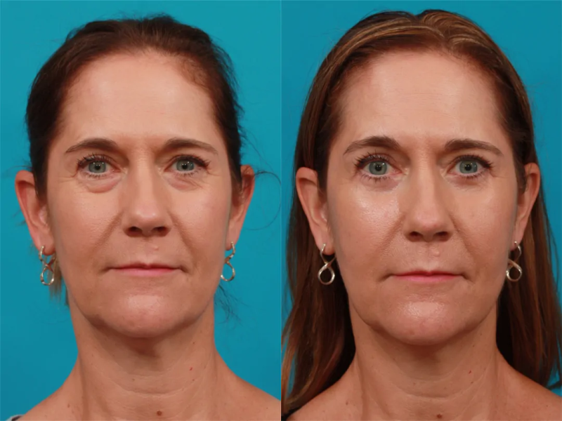 Пациентка пластического хирурга Гукаса Миракяна. Фото до и после операции по пластике век