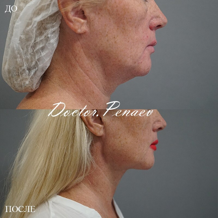 Пациентка доктора Арслана Пенаева до и после омоложения лица по авторской методике