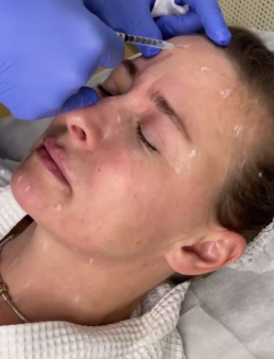 Ботулинотерапия против морщин