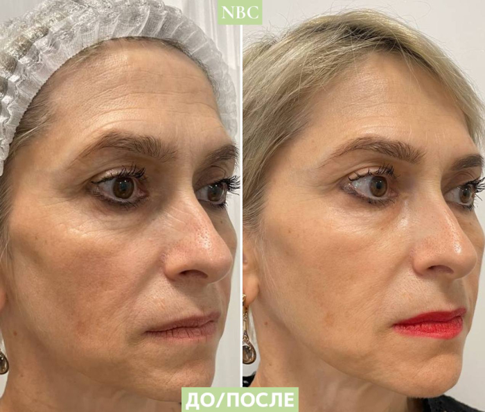 Пациентка клиники NBC до и после процедуры микроигольчатый RF-лифтинг лица