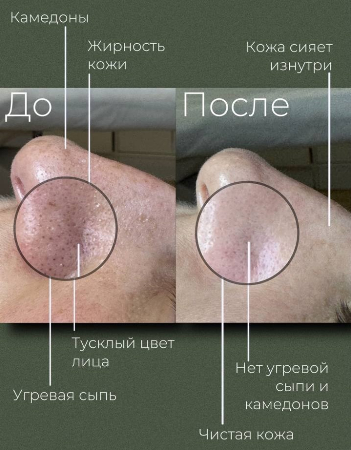 Пациентка клиники NBC до и после чистки лица и лазерного омоложения