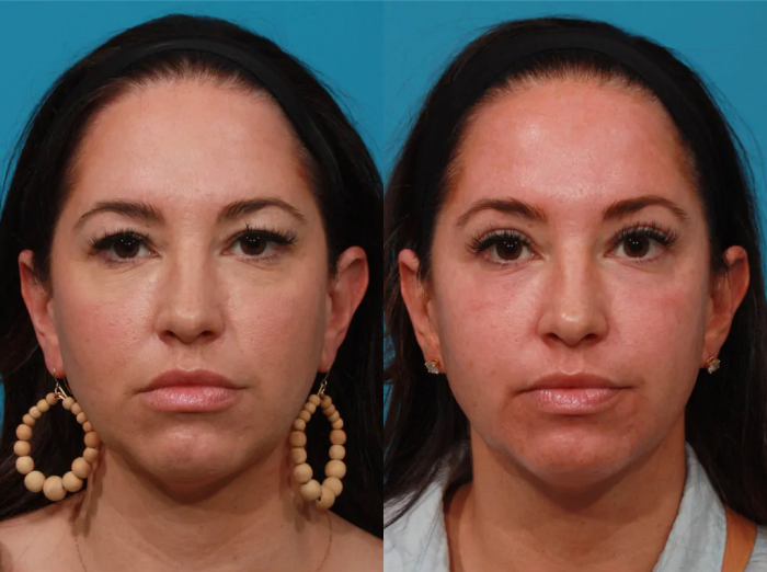 Пациентка пластического хирурга Гукаса Миракяна до и после операции по блефаропластике