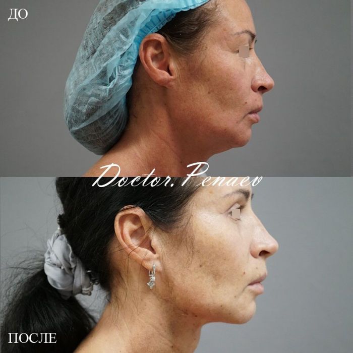 Пациентке хирурга Пенаева выполнен мультитехнологичный малоинвазивный лифтинг лица