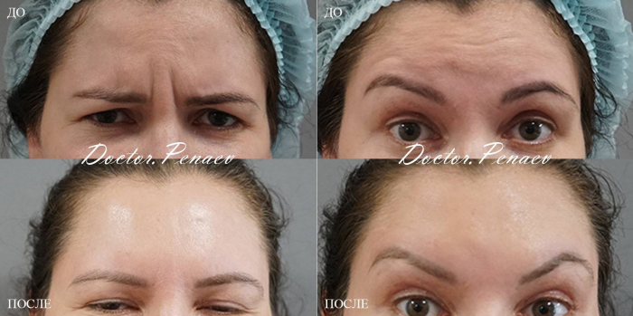 Пациентка доктора Арслана Пенаева. Фото до и после омоложения лба при помощи авторского метода «Вечный ботокс»