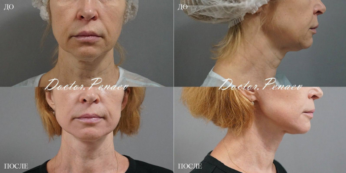 Пациентка доктора Арслана Пенаева до и после смас-лифтинга лица