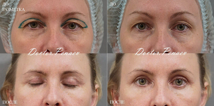 Пациентка доктора Арслана Пенаева до и после верхней и нижней блефаропластики