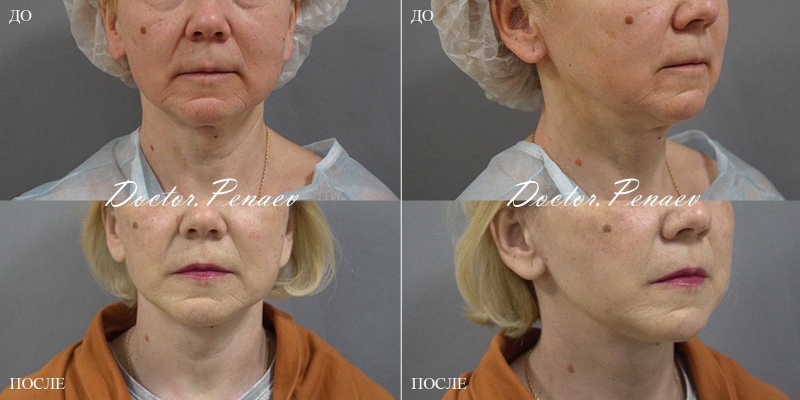 Пациентка (54 года) доктора Пенаева до и после смас-пластики лица