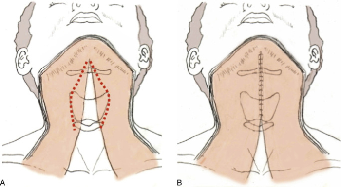 Подтяжка шеи/платизмопластика