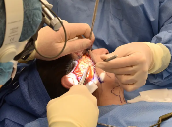 Как перейти от инъекций к подтяжке лица