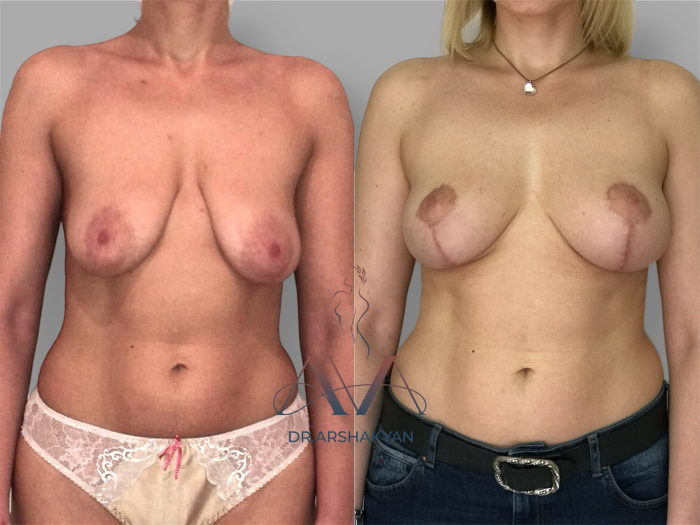 Пациентка доктора Вардана Аршакяна до и после операции по подтяжке груди