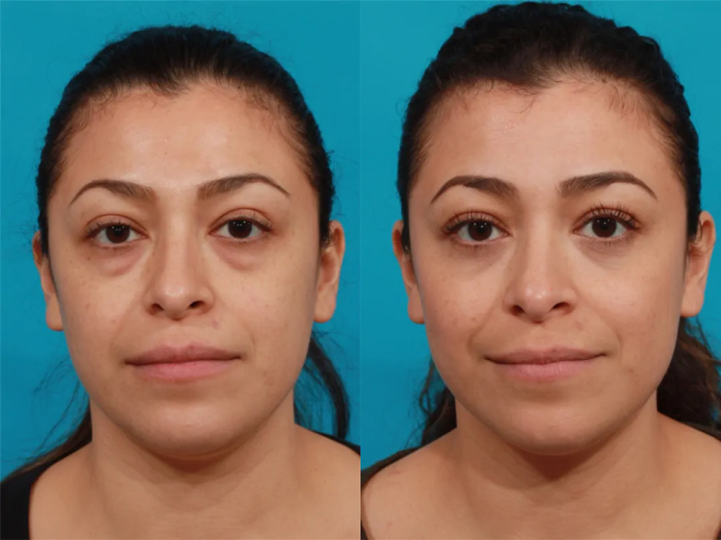 Пациентка пластического хирурга Миракяна Г.С Фото до и после круговой блефаропластики