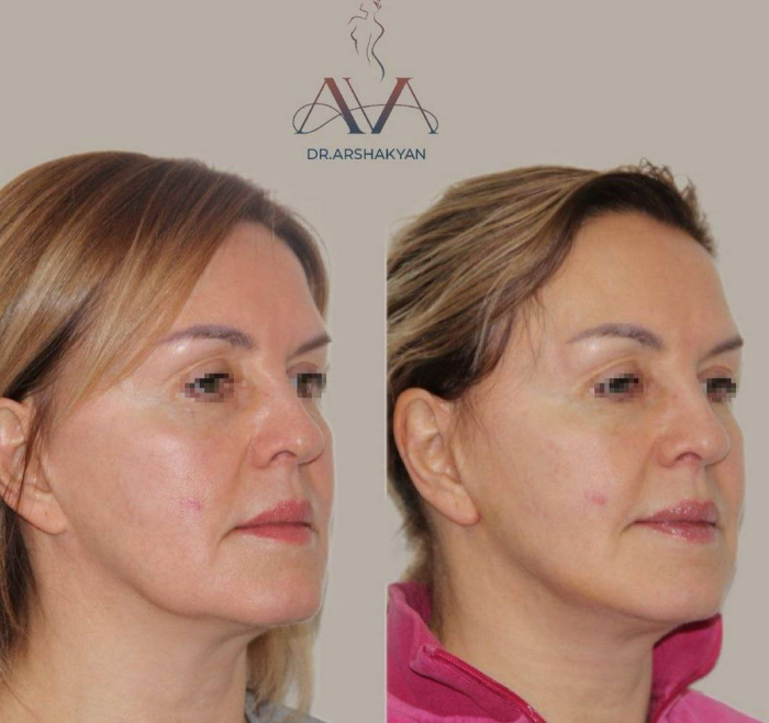 Пациентка доктора Вардана Аршакяна до и после радиочастотного омоложения лица FaceTite
