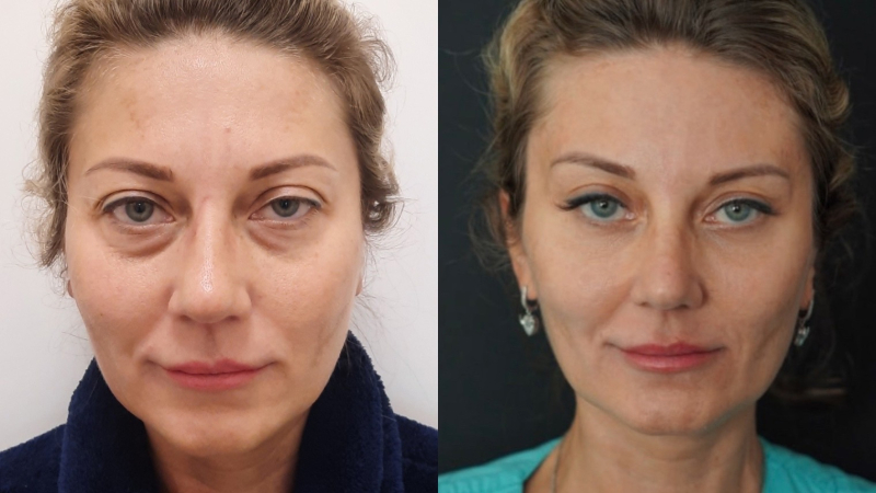 Пациентка доктора Елены Сухопаровой до и после омоложения лица