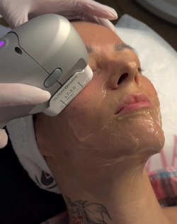 Ультразвуковой SMAS-лифтинг