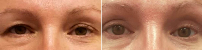 Микрохирургическая блефаропластика. Фото до и после. Доктор Лилит Чолоян