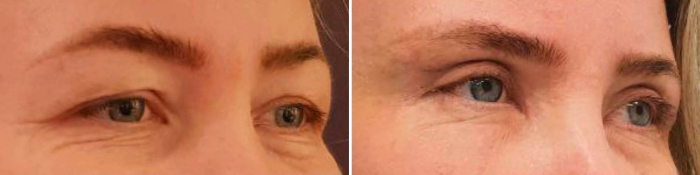 Микрохирургическая блефаропластика. Фото до и после. Доктор Лилит Чолоян