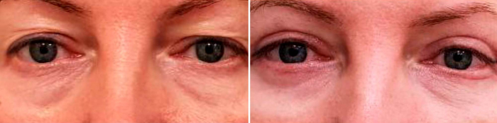 Микрохирургическая блефаропластика. Фото до и после. Доктор Лилит Чолоян