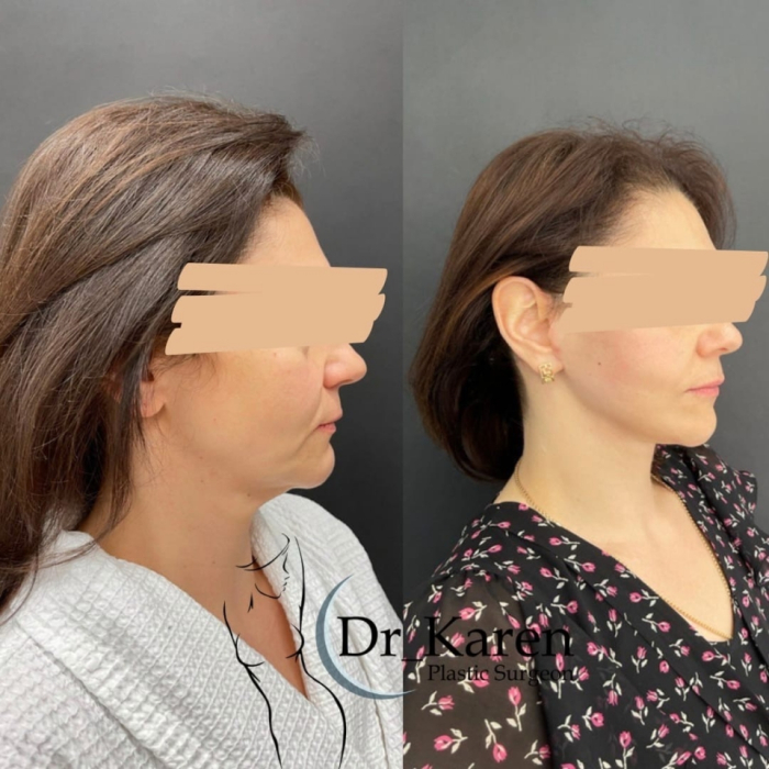 Пациентка пластического хирурга Карена Пайтяна. Фото до и после операции по SMAS-подтяжке лица