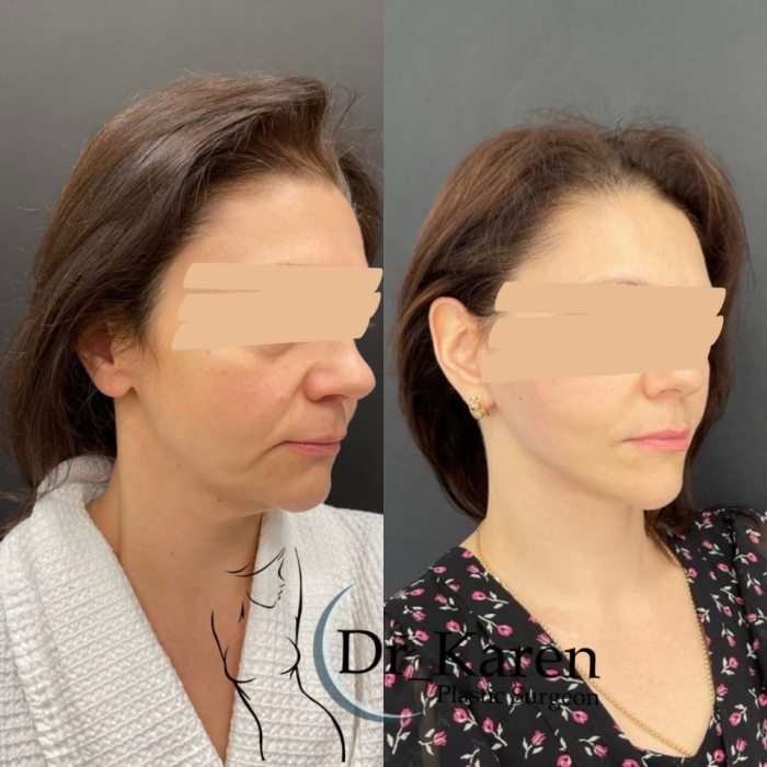 Пациентка пластического хирурга Карена Пайтяна. Фото до и после операции по SMAS-подтяжки лица