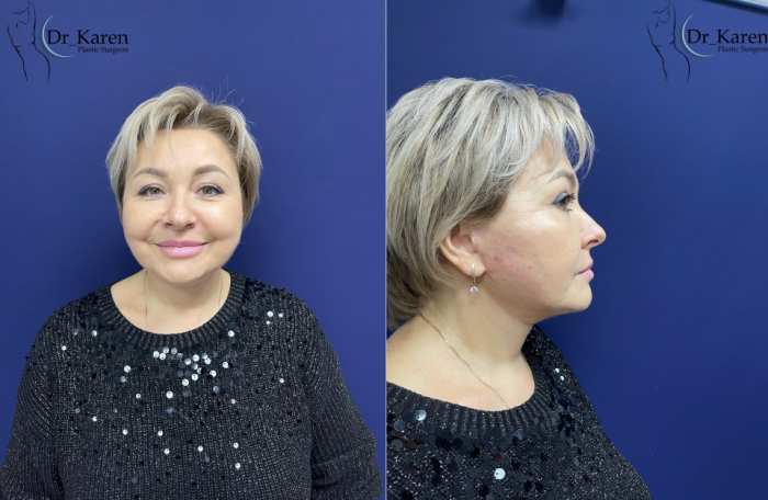 Пациентка пластического хирурга Карена Пайтяна после СМАС-лифтинга лица