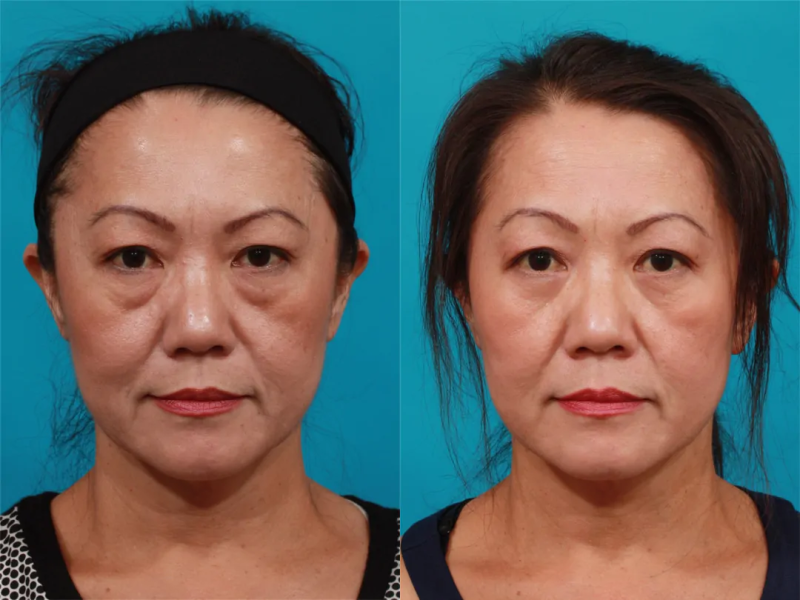 Пациентка пластического хирурга Гукаса Миракяна. Фото до и после операции по нижней блефаропластике