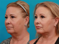 Пациентка пластического хирурга Гукаса Миракяна. Фото до и после операции по фейсдифтингу