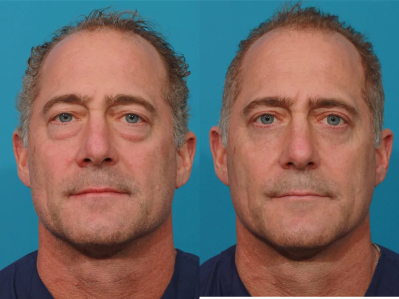 Пациент пластического хирурга Гукаса Миракяна. Фото до и после операции по пластике век