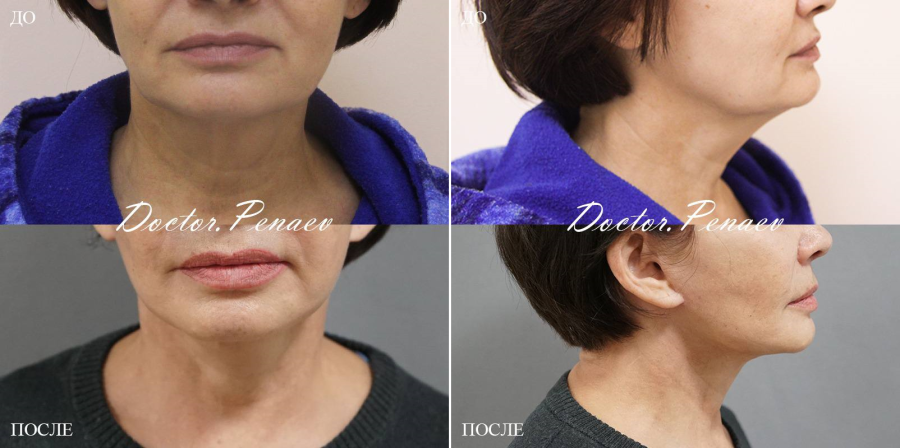 Пациентка (52 года) пластического хирурга Арслана Пенаева до и после омоложения лица