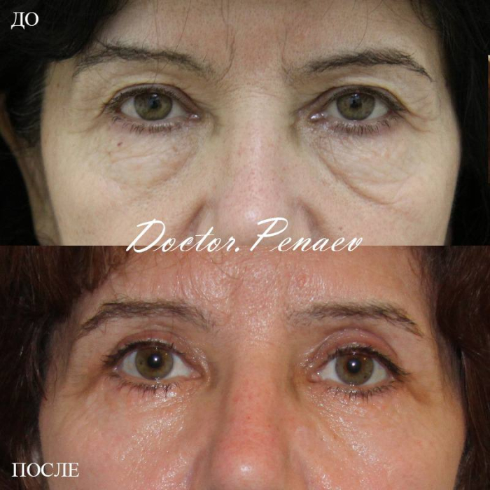 Пациентка доктора Пенаева А.А. до и после блефаропластики верхних и нижних век