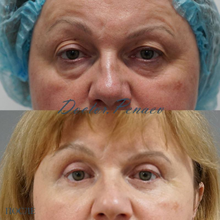 Пациентка доктора Пенаева А.А. до и после блефаропластики верхних и нижних век