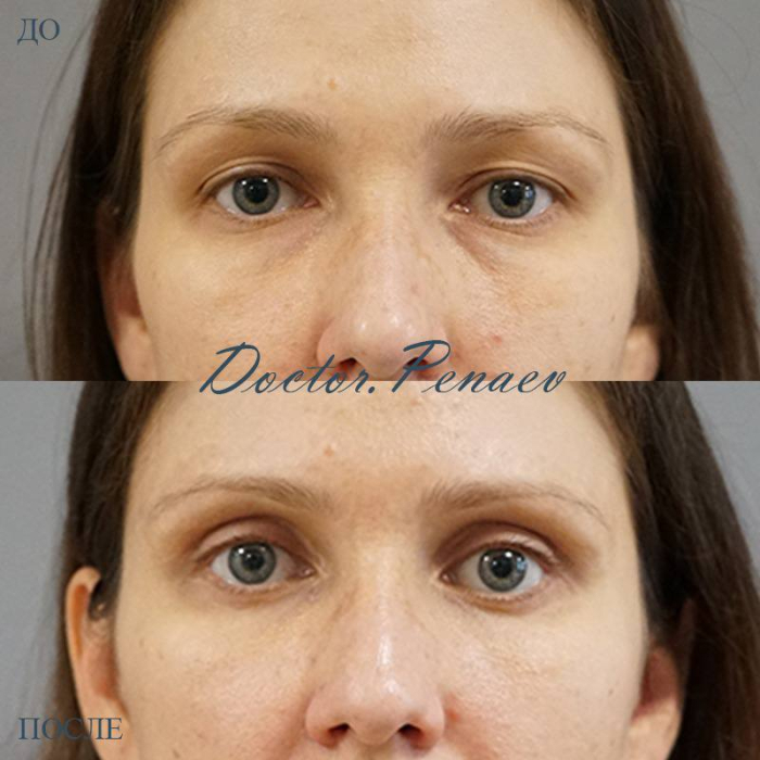 Пациентка доктора Арслана Пенаева до и после блефаропластики
