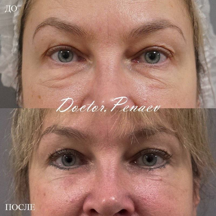 Пациентка доктора Арслана Пенаева до и после блефаропластики