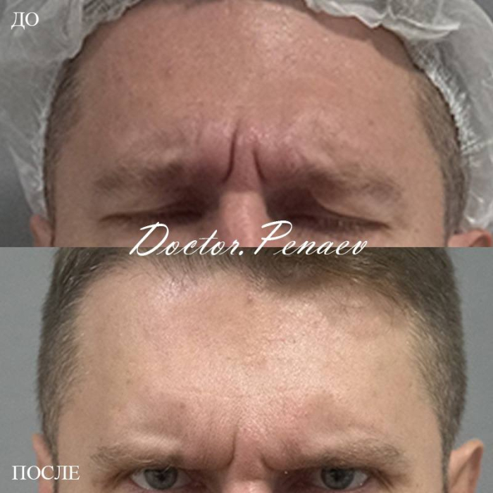 Выполнена блефаропластика верхних век и авторская методика «Вечный ботокс»