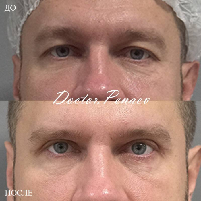 Выполнена блефаропластика верхних век и авторская методика «Вечный ботокс»