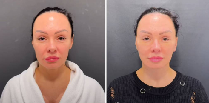 Спейслифтинг до и после