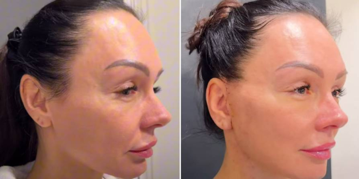 Спейслифтинг до и после