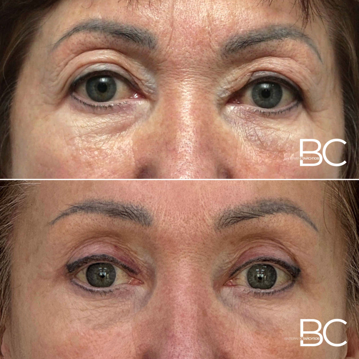 Пациентка В.Ю. Стайсупова до и через 10 дней после периорбитопластики