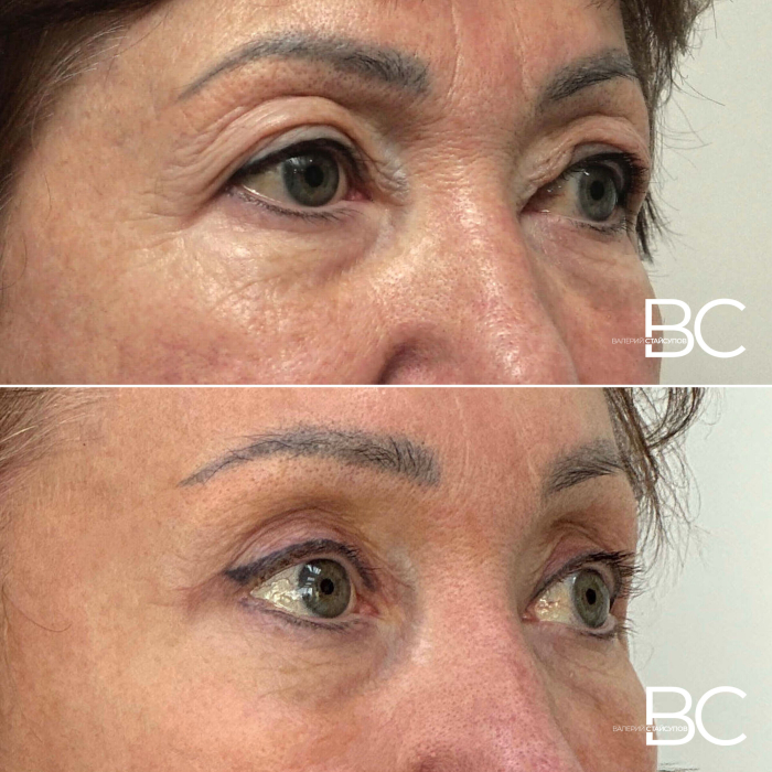 Пациентка В.Ю. Стайсупова до и через 10 дней после периорбитопластики