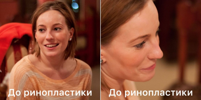 Пациентка В.Ю. Стайсупова до ринопластики