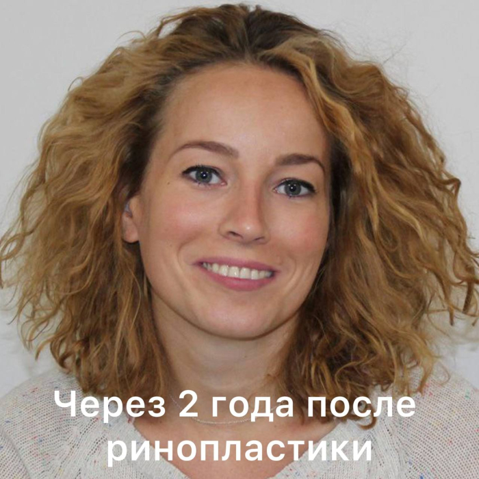 Пациентка Стайсупова после ринопластики