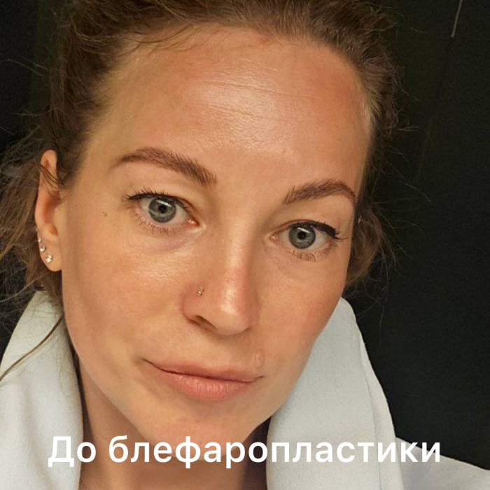 Пациентка до блефаропластики