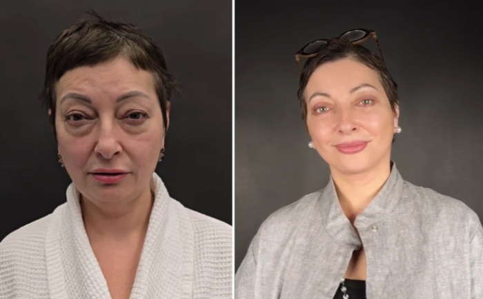 Та же пациентка до и после