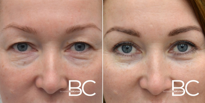 Блефаропластика до и после
